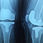 Knee replacement physical therapy